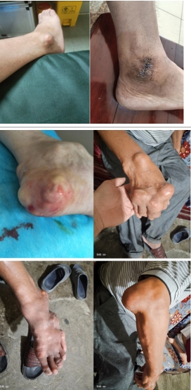 痛风结石老鼠疮乳腺增生无效退款广西百色杨忠雅医师